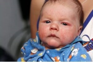 Lehet, hogy ez egy allergia squash a baba, és milyen reakciót a kocsmában az első csalit