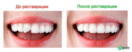 Întinderea dinților, contraindicații, demnitatea protezelor