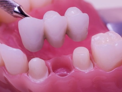 Construcția dentară cât costă, dacă doare, care sunt argumentele pro și contra, cum