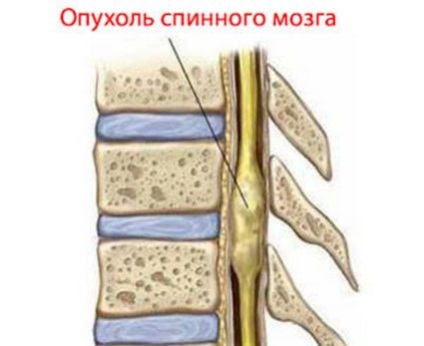 Tumorile simptomelor și tratamentului măduvei spinării