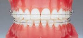 Orapix! Ortodonția linguală devine mai eficientă, mai confortabilă și ... mai mult