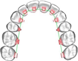 Orapix! Ortodonția linguală devine mai eficientă, mai confortabilă și ... mai mult