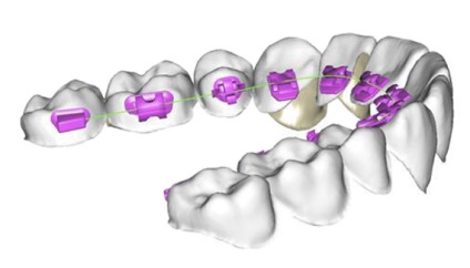 Orapix - sistem de arc drept în ortodonție