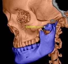 Osteomul osului - tratament, simptome, cauze