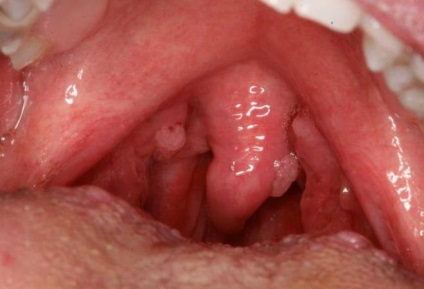 Papilloma în gâtul locului de apariție, metode de îndepărtare și tratament