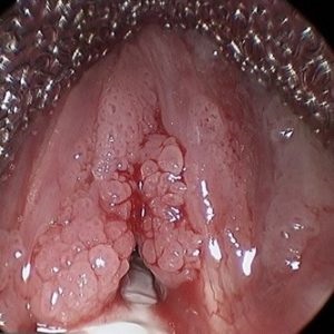 Papilloma în gât Simptomele, tipurile și pericolul bolii