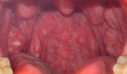 Papilloma în gât Simptomele, tipurile și pericolul bolii
