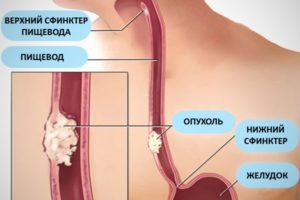 Papilloma în gât Simptomele, tipurile și pericolul bolii