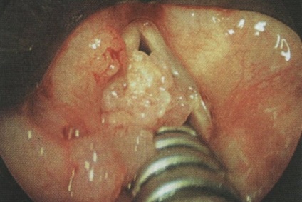 Papilloma torok tünetek típusa és a betegség kockázatának