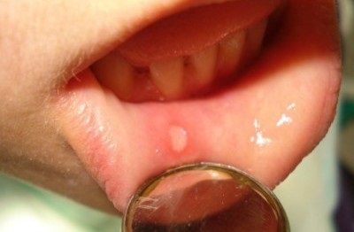 Papilloma în tratamentul și înlăturarea gurii