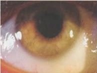 Anterior uveitis vagy iridocyclitis