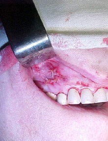 Periostotomie (deschiderea unui abces) - centrul de îngrijire a denturii pentru medicina estetică