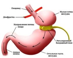 Pro și contra grefă bypass gastric - orașul regiunii Moscova