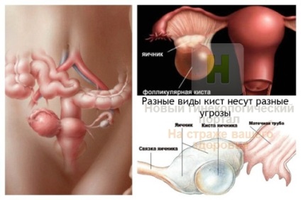 Következmények és szövődményei petefészek ciszta kezelés Moszkva, a tünetek, komplikációk, megelőzés