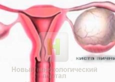 Consecințele și complicațiile chisturilor ovariene la Moscova, simptome, complicații, prevenire