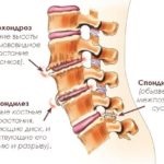 Simptome și tratament pentru osteocondrosisul lombosacral