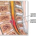 Simptome și tratament pentru osteocondrosisul lombosacral