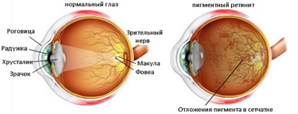 Cauzele abiotrofiei retinale la copii și adulți - diagnosticul și tratamentul patologiei