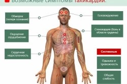 Причини тахікардії при низькому тиску