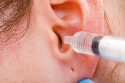 Plutele în urechi sau cum să curăță urechile, indicațiile clinicii ENT - tratăm și operăm