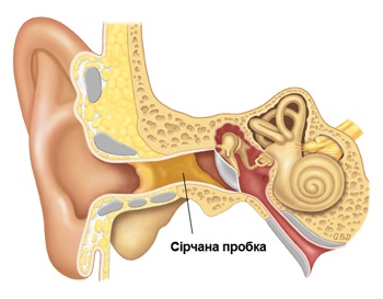 Dugók a füle, vagy hogyan kell tisztítani a fül, ENT Clinic dákó - kezelésére és üzemeltetésére