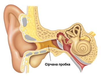 Plutele în urechi sau cum să curăță urechile, indicațiile clinicii ENT - tratăm și operăm
