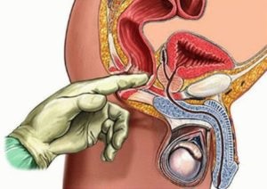 Profilaxia cu exacerbarea prostatitei, prostatitei cronice în stadiul acut și prevenirea