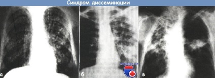 Radiológiai szindrómák tuberculosis