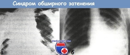 Radiológiai szindrómák tuberculosis