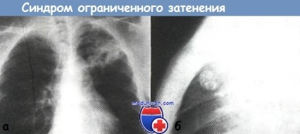 Radiológiai szindrómák tuberculosis