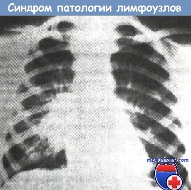 Sindroamele cu raze X în tuberculoză
