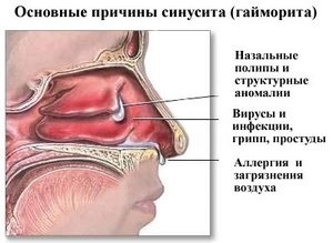 Sinusită simptome ale bolii, cauze și tratament