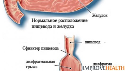 Alunecarea simptomelor și tratamentului diafragmei Hernia Hernia
