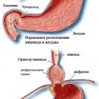 Csúszó hiatus hernia tünetek és a kezelés