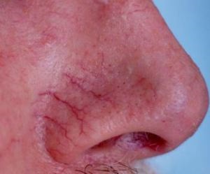 Asteriscuri vasculare pe fața cauzei, metode de prevenire și tratament
