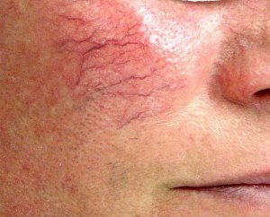 Asteriscuri vasculare pe fața cauzei, metode de prevenire și tratament