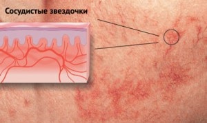 Asteriscuri vasculare pe fața cauzei, metode de prevenire și tratament