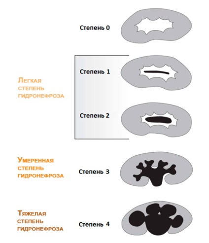 Gradele hidronefrozei și modul de determinare a acestora
