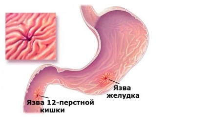 Ulcerul stresului