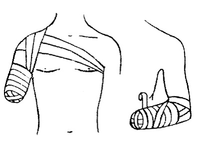 Bandaje tipice pe abdomen, perineu, membre