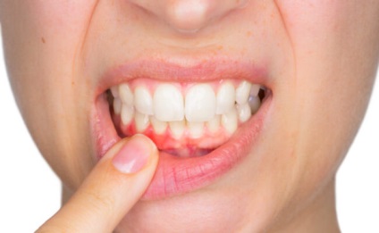 Consolidarea gingiilor și dinților pierduți cu remedii folclorice - metode eficiente!