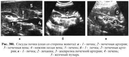 Examinarea cu ultrasunete a rinichilor