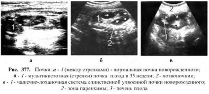 Examinarea cu ultrasunete a rinichilor