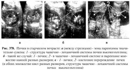 Examinarea cu ultrasunete a rinichilor