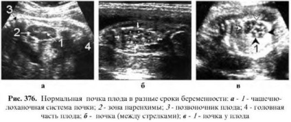 Examinarea cu ultrasunete a rinichilor