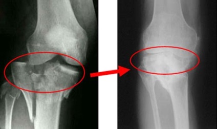 Nuanțele importante decât artroza diferă de gonartroza articulațiilor genunchiului, articulația gonartrozei coxartrozei
