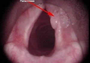 Tipuri de papilome în gât