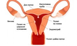 Răzuirea polipului endometrial în uterul trăsăturii