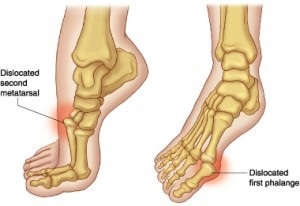 Dislocarea picioarelor principalelor simptome și metode de tratament ce trebuie făcut și cum se tratează picioarele dislocate - secretele sănătății