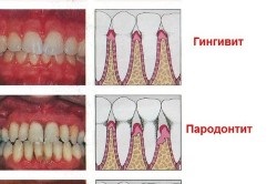 Inflamația gingiei în timpul sarcinii ce să facă și cum să se trateze